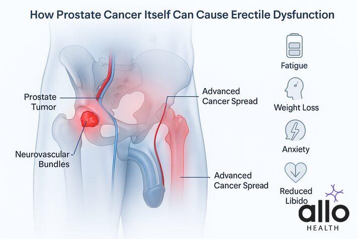Can the Prostate Cancer Itself Cause Erectile Dysfunction? Yes, though it’s less common than cancer treatment-related ED, the prostate cancer tumor itself can directly affect sexual function, especially in more advanced cases. Here’s how: Pressure on Nerves or Blood Vessels: If the tumor grows large or invades nearby areas, it can press on the nerves and blood vessels that help control erections, especially the neurovascular bundles or pelvic nerves. Advanced or Metastatic Cancer: In later stages, the tumor may spread beyond the prostate. This can lead to gradual or sudden erection loss, sometimes along with pelvic pain or urinary problems. Systemic Effects of Cancer: Prostate cancer can also cause fatigue, weight loss, and emotional stress, all of which lower energy, reduce libido, and contribute to ED. Cancer-Related Anxiety: Even before treatment begins, the emotional toll of a cancer diagnosis can disrupt sexual desire and function. 