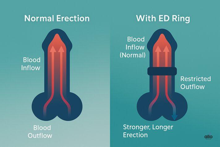 infographic showing how constriction rings for erectile dysfunction work by restricting blood outflow at the base of the penis, comparing normal blood flow with reduced outflow when using a ring.