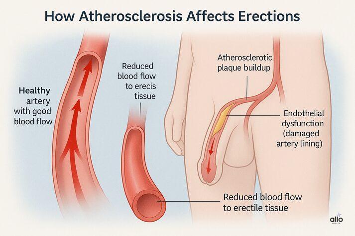 “3D medical illustration showing how atherosclerosis causes erectile dysfunction by narrowing arteries and reducing blood flow to the penis.”